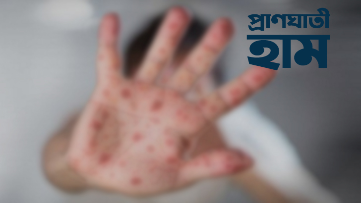 শিশুকে হাম থেকে বাঁচাতে যা করবেন