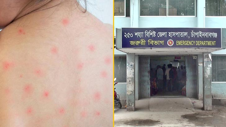 চাঁপাইনবাবগঞ্জে হামের উপসর্গ নিয়ে এক শিশুর মৃত্যু